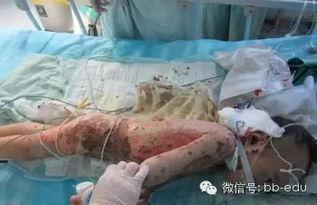 成人烫伤新闻视频播放