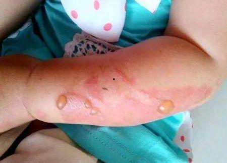 成人烫伤新闻视频播放