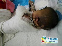 成人烫伤新闻视频播放